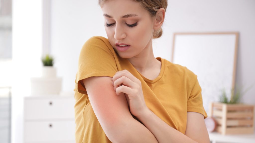 Scabies rash 3