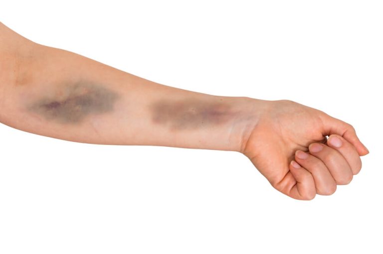 What are Bruises? Guide about Types of Bruises and Its Duration