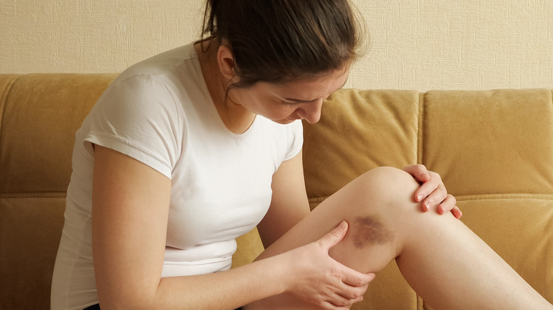 Treatment of Bruises