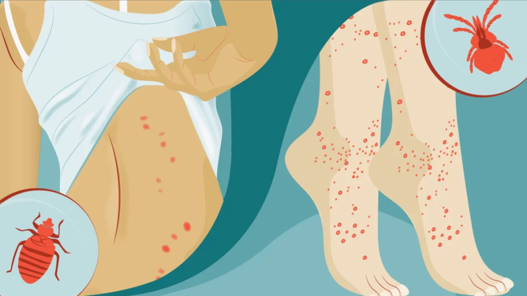 Chigger Bites
